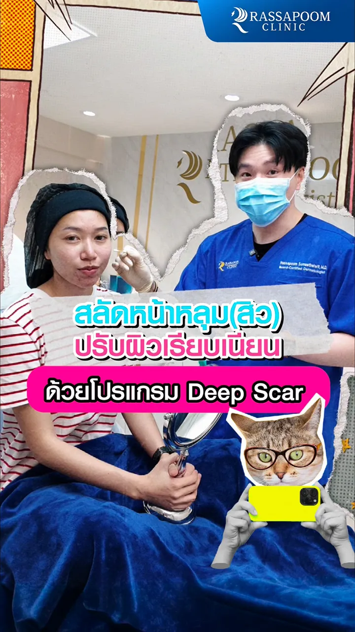 โปรแกรม DEEP SCAR เกลี่ยผิว กลบหลุมสิว ให้เรียบเนียน