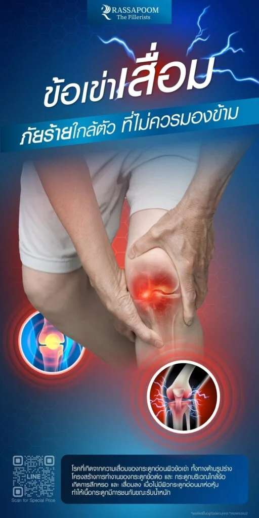 โปรแกรมรักษาข้อเข่าเสื่อม Knee Osteoarthritis