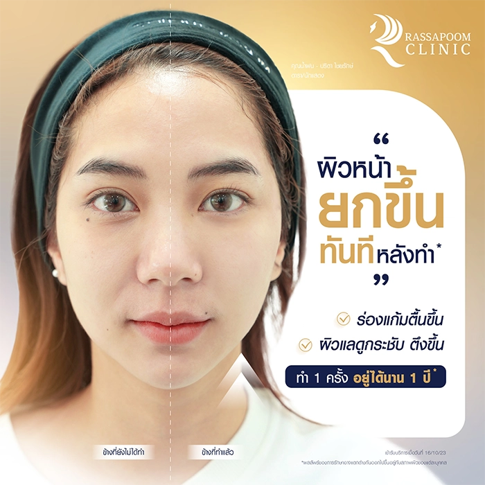 โปรแกรม New Ulthera SPT ยกชับใบหน้า (คุณฝน ปริตา ไชยรักษ์)